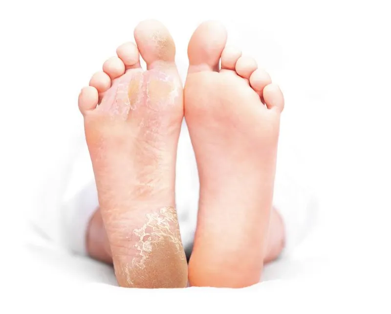 Bild 5 för Baby Foot Exfoliation Foot Peel For Men