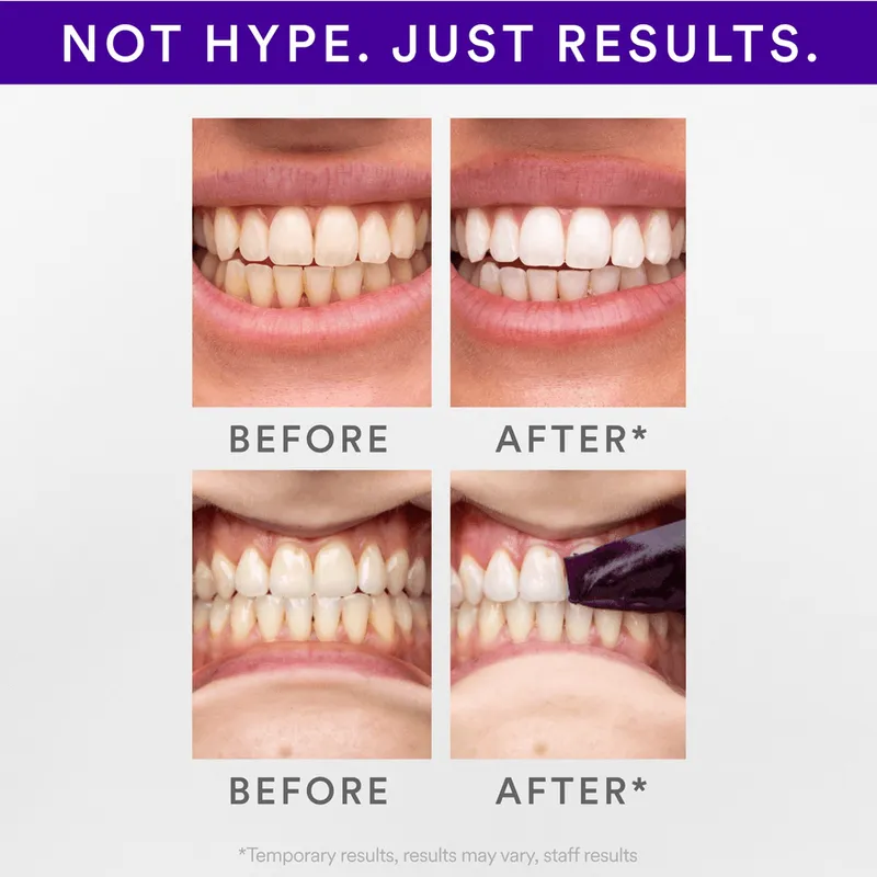 Bild 5 för Hismile V34 Teeth Whitening Strips
